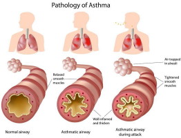 astma1_1